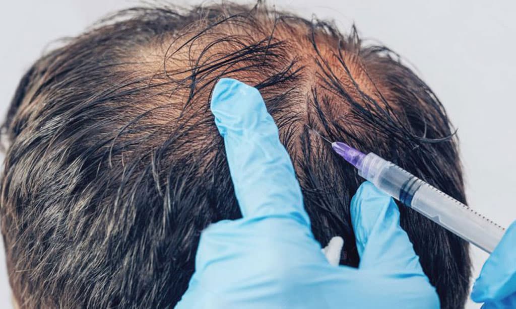 Mesoterapia