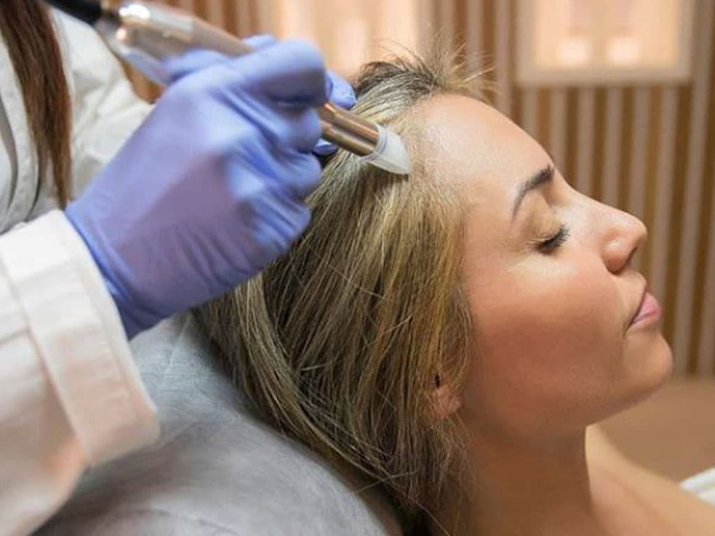 Microneedling